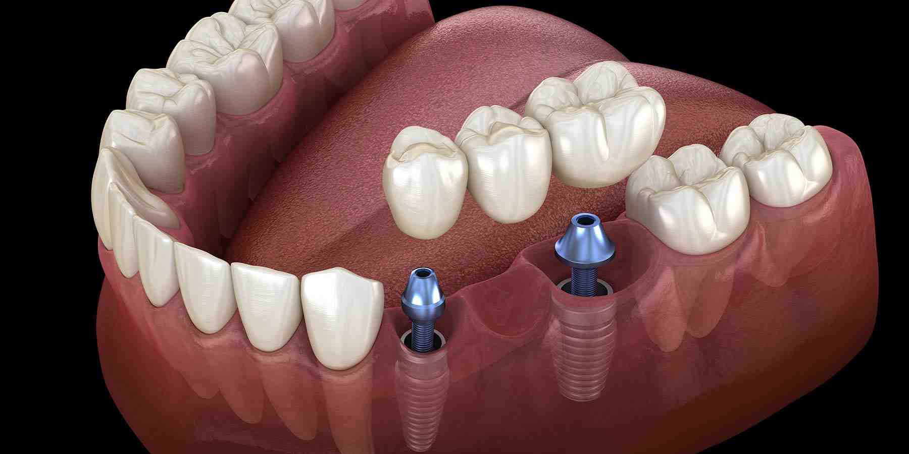 implant